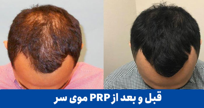 قبل-و-بعد-از-PRP-