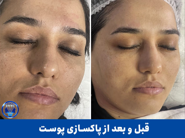 قبل-و-بعد-از-فیشیال-