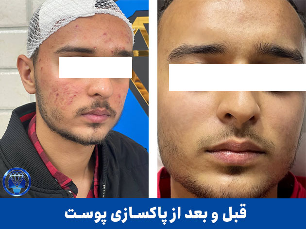 قبل-و-بعد-از-فیشیال-