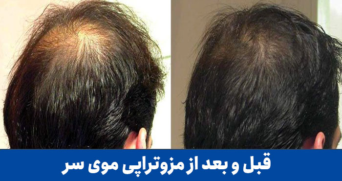 قبل-و-بعد-از-مزوتراپی-مو