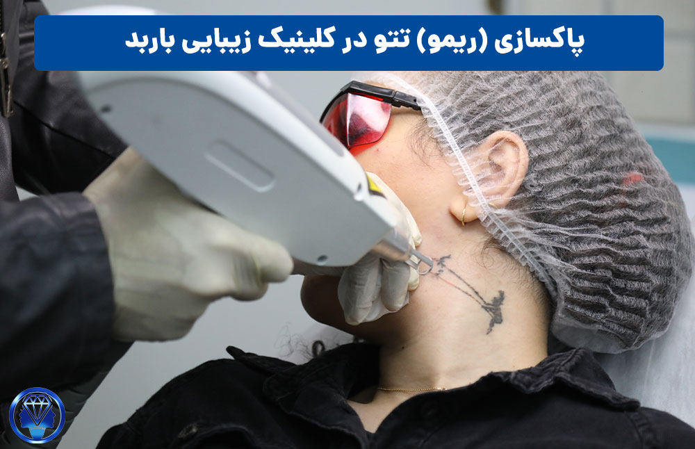 پاکسازی تتو با لیزر