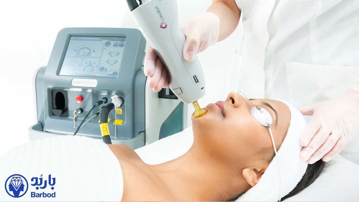 لیزر موهای زائد در شمال تهران با دستگاه کندلا