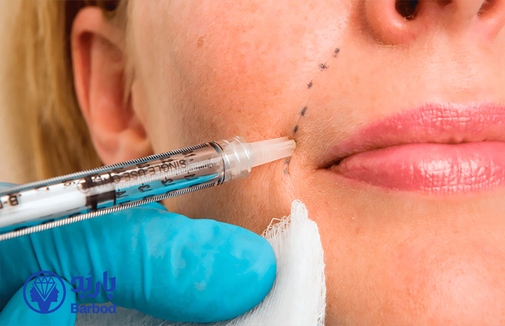 فیلر-خط-خنده-در-تهران-کاور