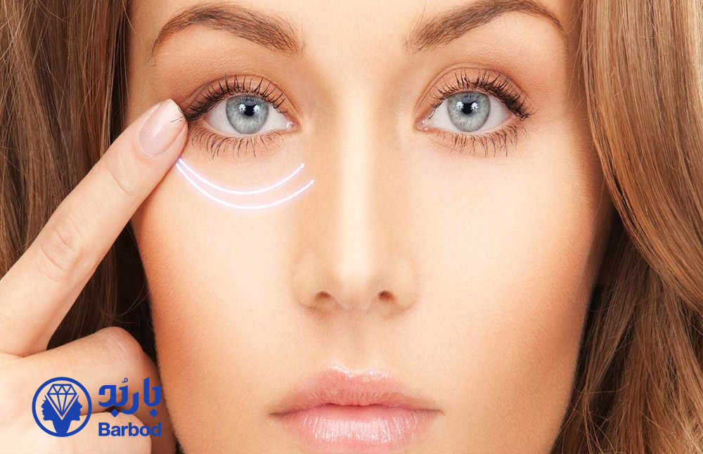 فیلر-زیر-چشم