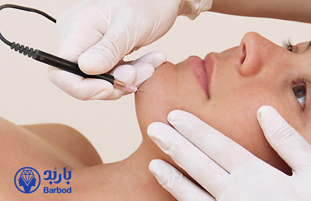 الکترولیز-موهای-سفید