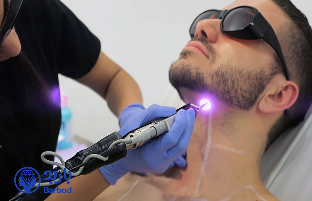 لیزر-موهای-زائد-صورت-آقایان