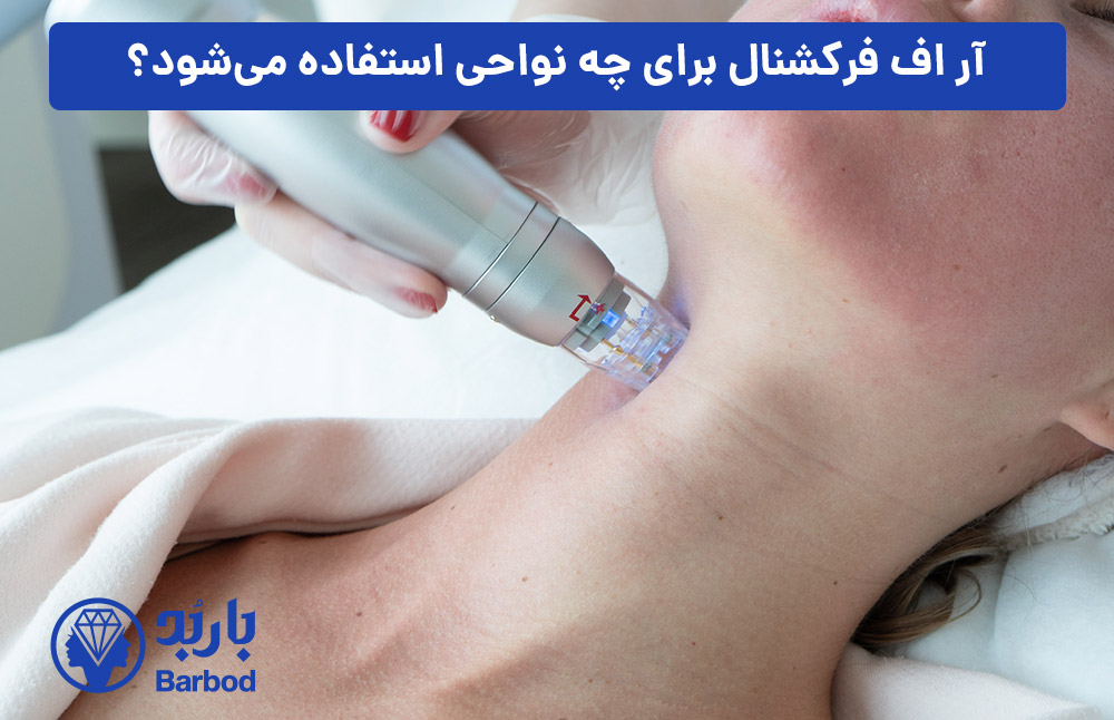 آر-اف-فرکشنال-برای-چه-نواحی-استفاده-می‌شود؟