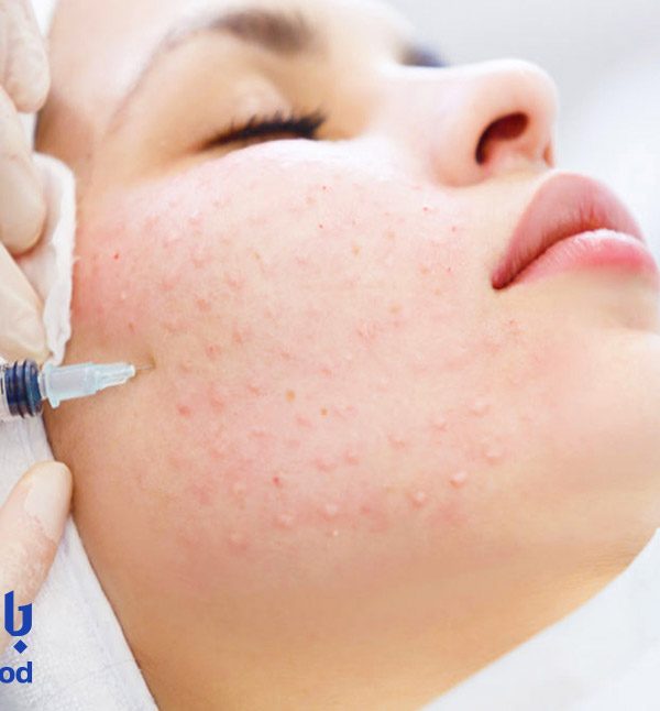 مزوتراپی-صورت-برای-رفع-لک