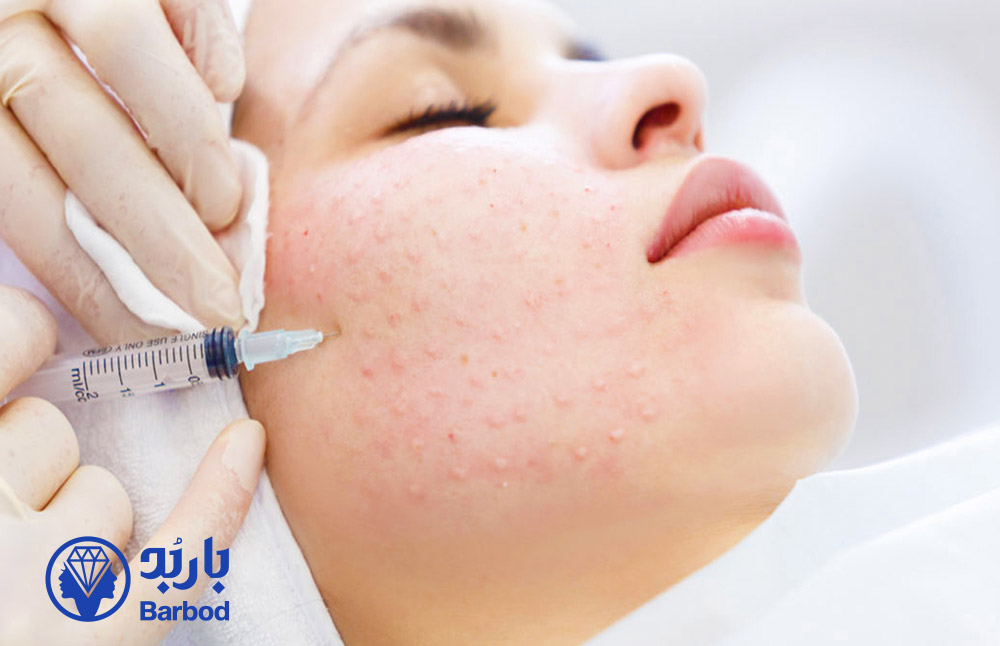 مزوتراپی-صورت-برای-رفع-لک