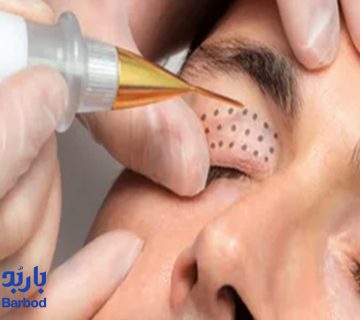 پلاسما-جت-پلک-در-تهران