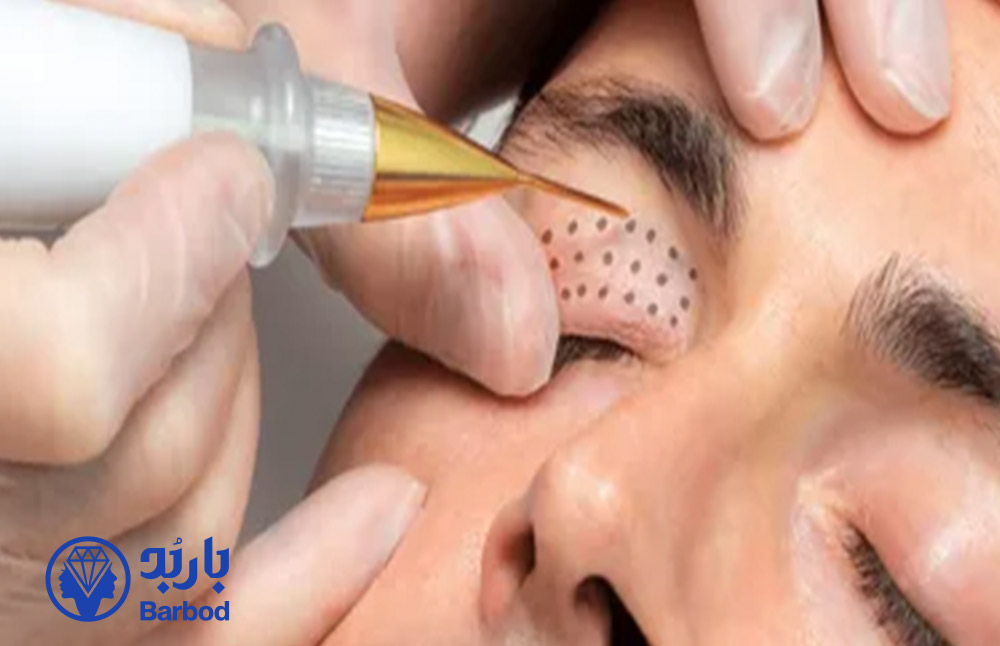 پلاسما-جت-پلک-در-تهران