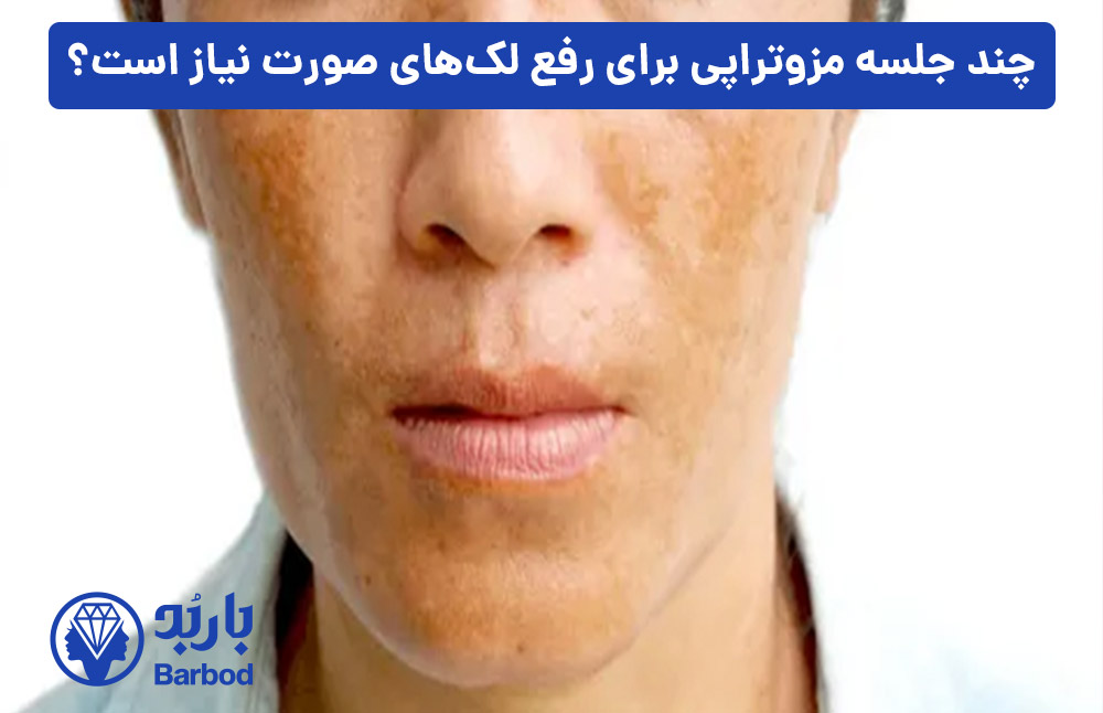 چند-جلسه-مزوتراپی-برای-رفع-لک‌های-صورت-نیاز-است؟