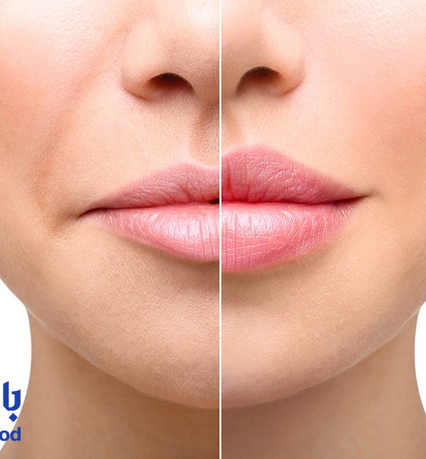 جدیدترین مدل‌ های تزریق ژل لب