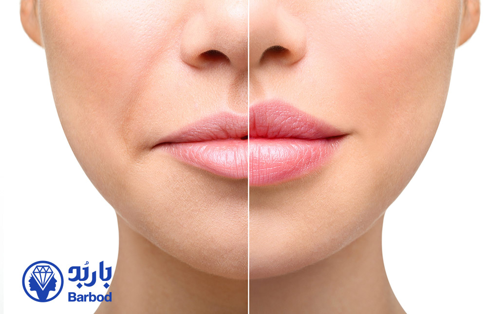 جدیدترین مدل‌ های تزریق ژل لب