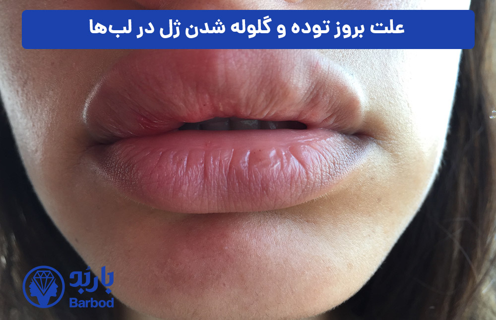 علت-بروز-توده-و-گلوله-شدن-ژل-در-لب‌ها
