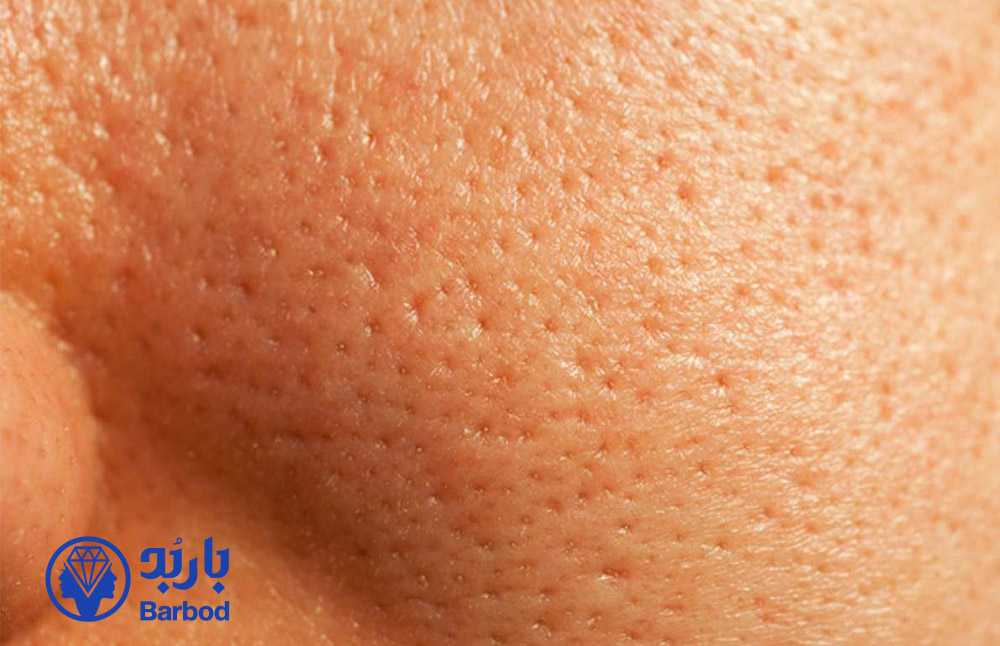 _درمان-پوست-پرتقالی