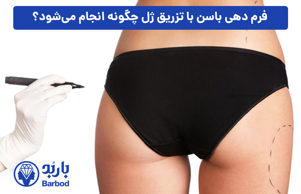 فرم‌-دهی-باسن-با-تزریق-ژل-چگونه-انجام-می‌شود؟