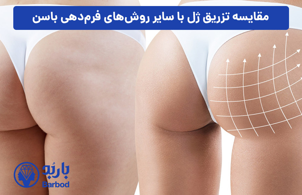 مقایسه-تزریق-ژل-با-سایر-روش‌های-فرم‌دهی-باسن