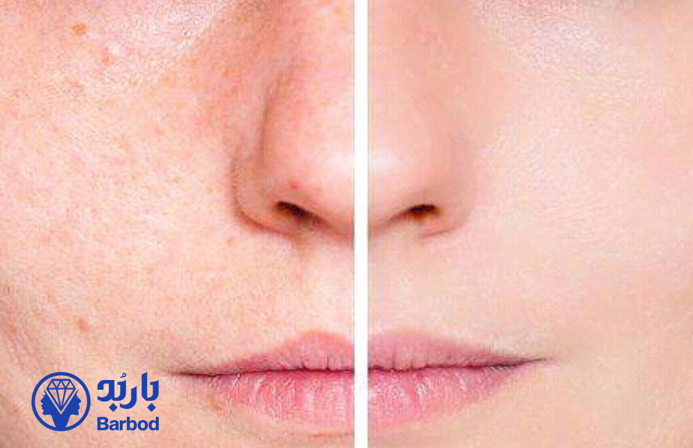 _رفع-منافذ-باز-صورت