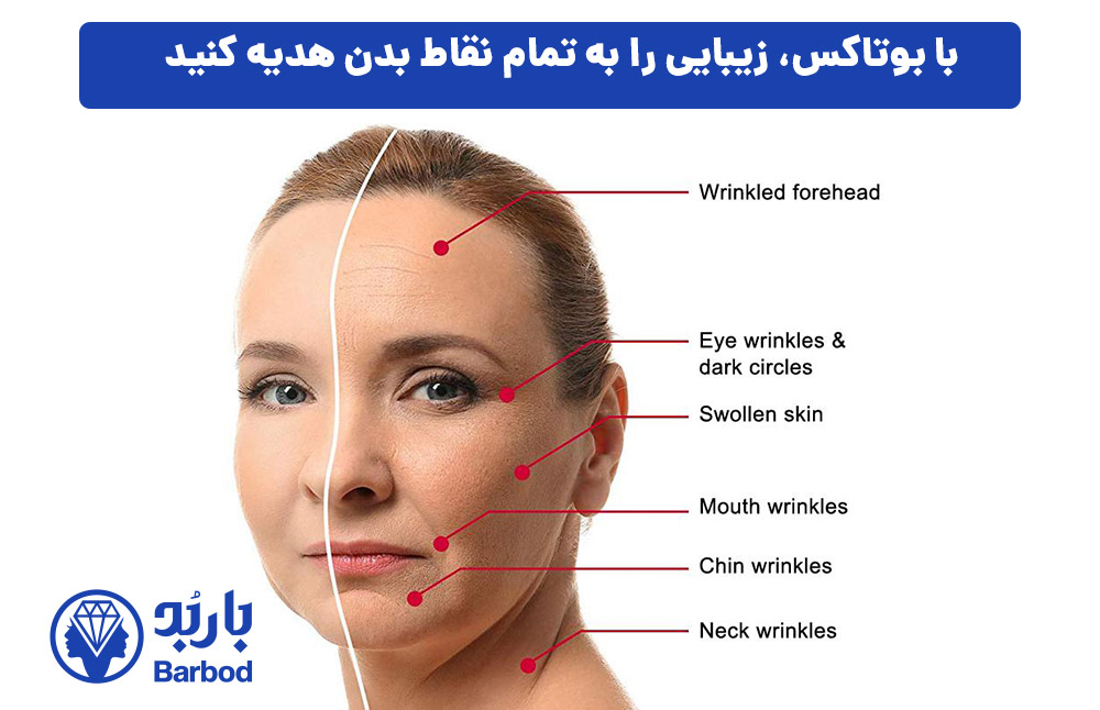 با بوتاکس، زیبایی را به تمام نقاط بدن هدیه کنید