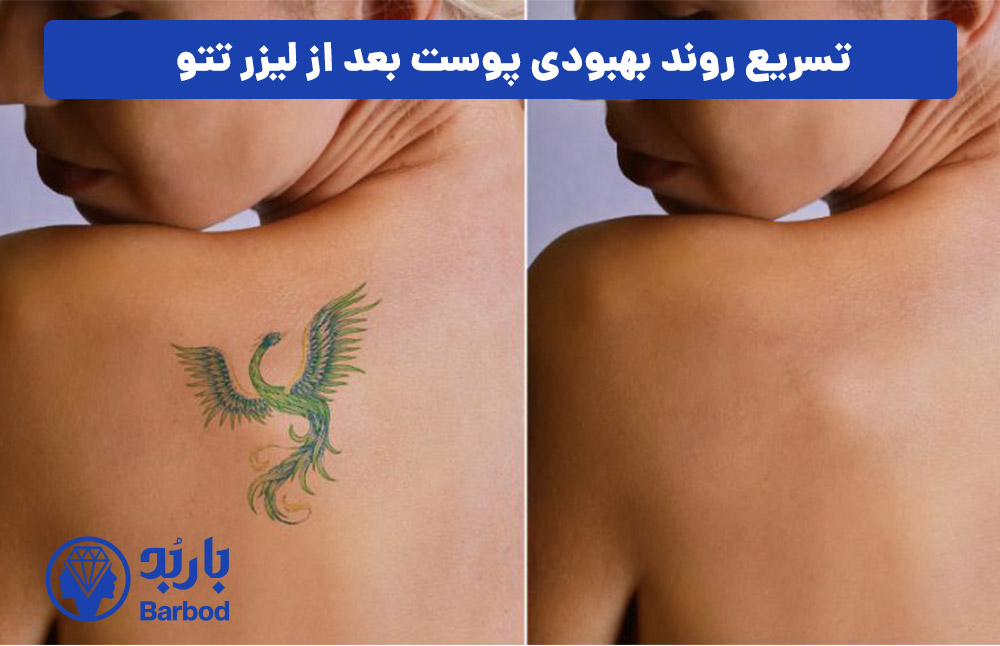 تسریع روند بهبودی پوست بعد از لیزر تتو