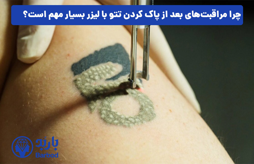 چرا مراقبت‌های بعد از پاک کردن تتو با لیزر بسیار مهم است؟