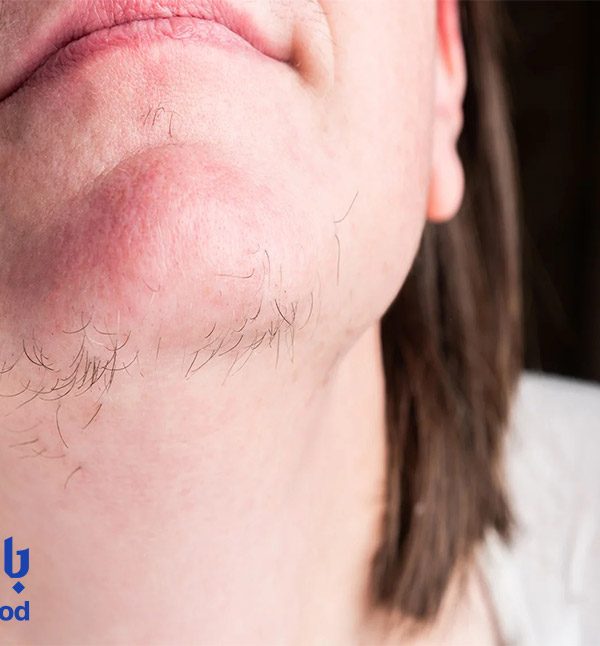 بهترین روش‌های موثر و ایمن برای از بین بردن موی چانه