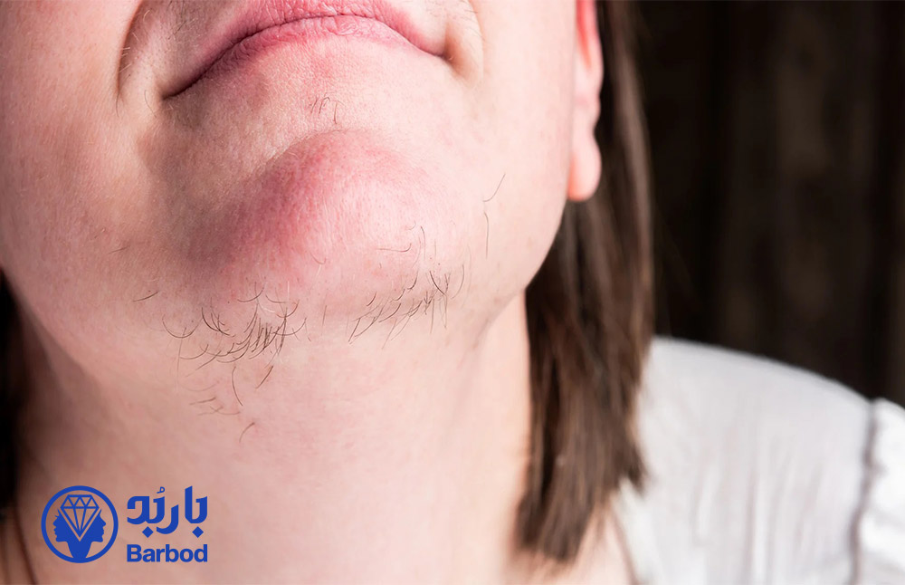 بهترین روش‌های موثر و ایمن برای از بین بردن موی چانه