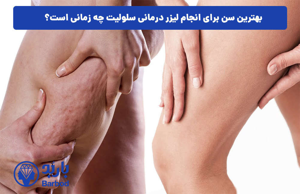 بهترین سن برای انجام لیزر درمانی سلولیت چه زمانی است؟