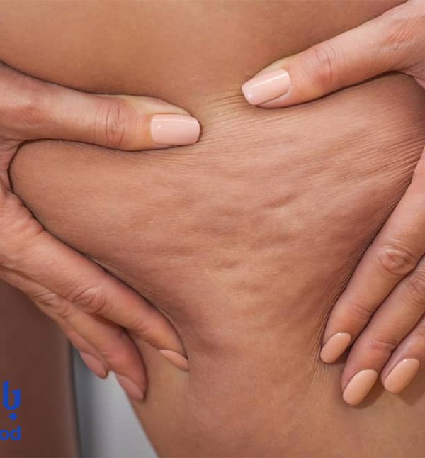 درمان قطعی سلولیت با لیزر