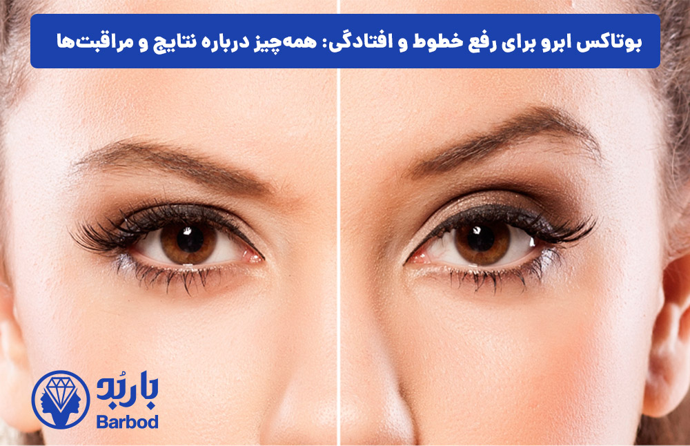 بوتاکس ابرو برای رفع خطوط و افتادگی: همه‌چیز درباره نتایج و مراقبت‌ها