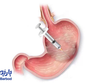 بوتاکس معده درتهران