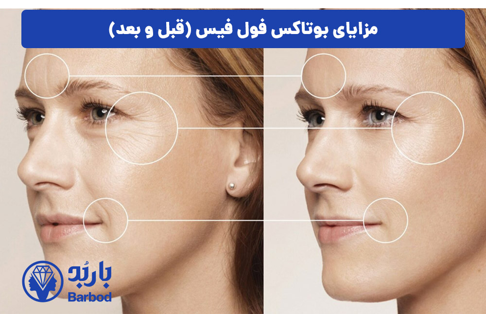 مزایای-بوتاکس-فول-فیس-در-تهران