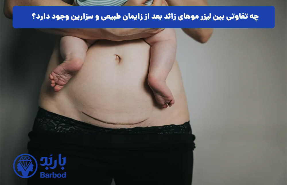 چه تفاوتی بین لیزر موهای زائد بعد از زایمان طبیعی و سزارین وجود دارد؟