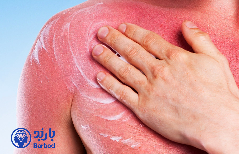 سوختگی بعد از لیزر موهای زائد؛ دلایل، روش‌های درمان و راه‌های پیشگیری