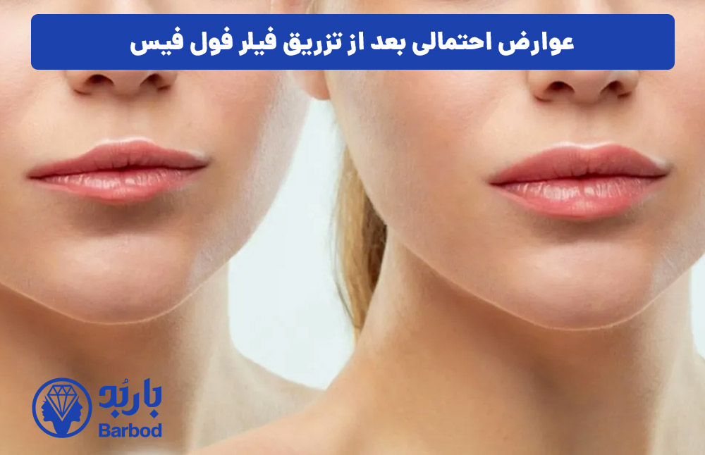 عوارض احتمالی بعد از تزریق فیلر فول فیس