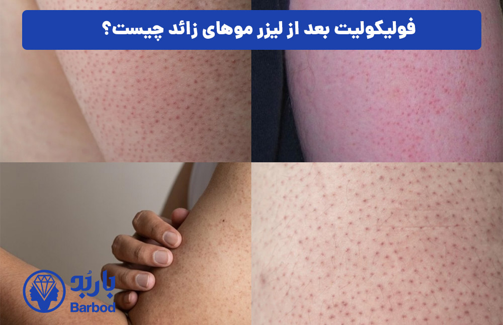 فولیکولیت بعد از لیزر موهای زائد چیست؟
