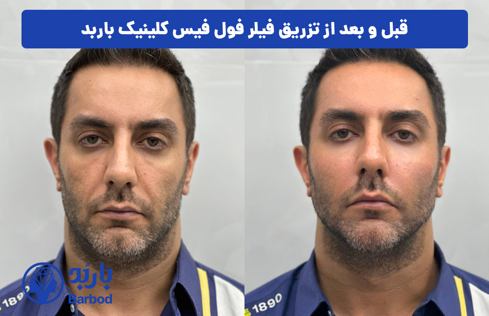 قبل و بعد فیلر فول فیس