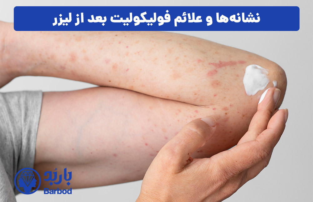 نشانه‌ها و علائم فولیکولیت بعد از لیزر