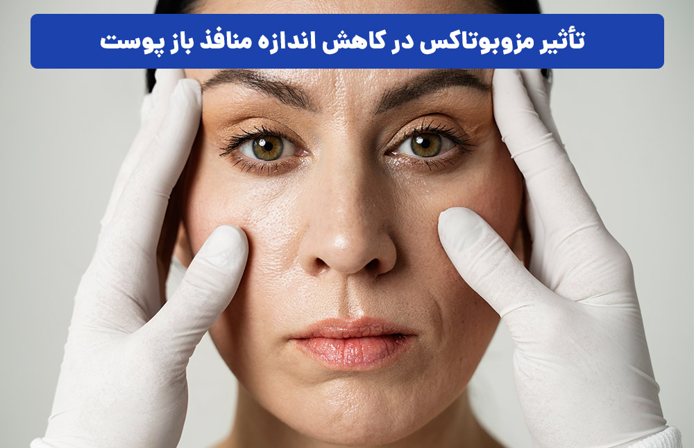 تأثیر مزوبوتاکس در کاهش اندازه منافذ باز پوست