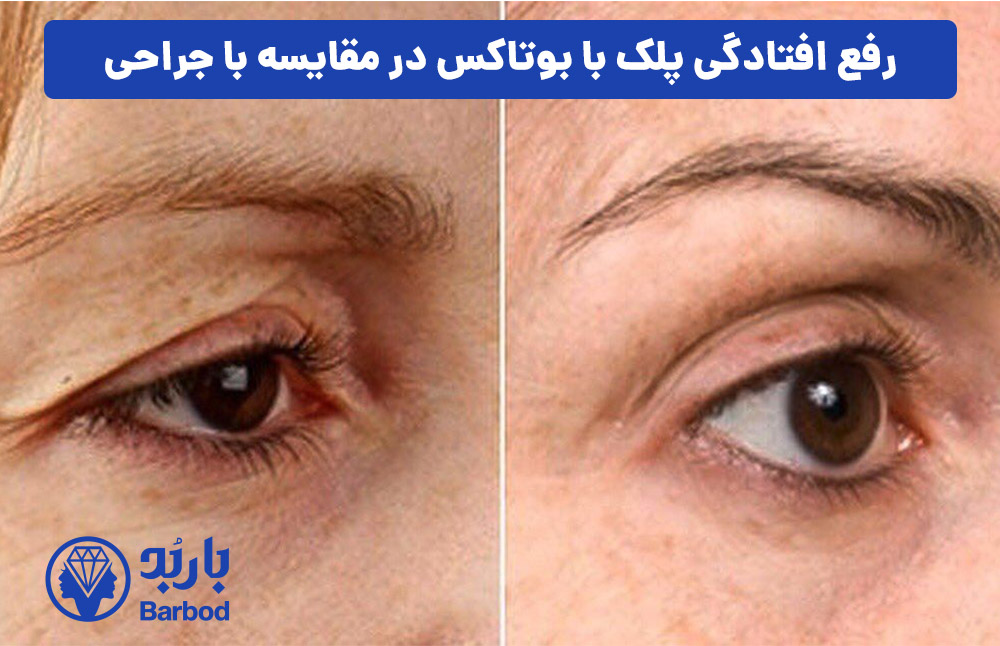 رفع افتادگی پلک با بوتاکس در مقایسه با جراحی