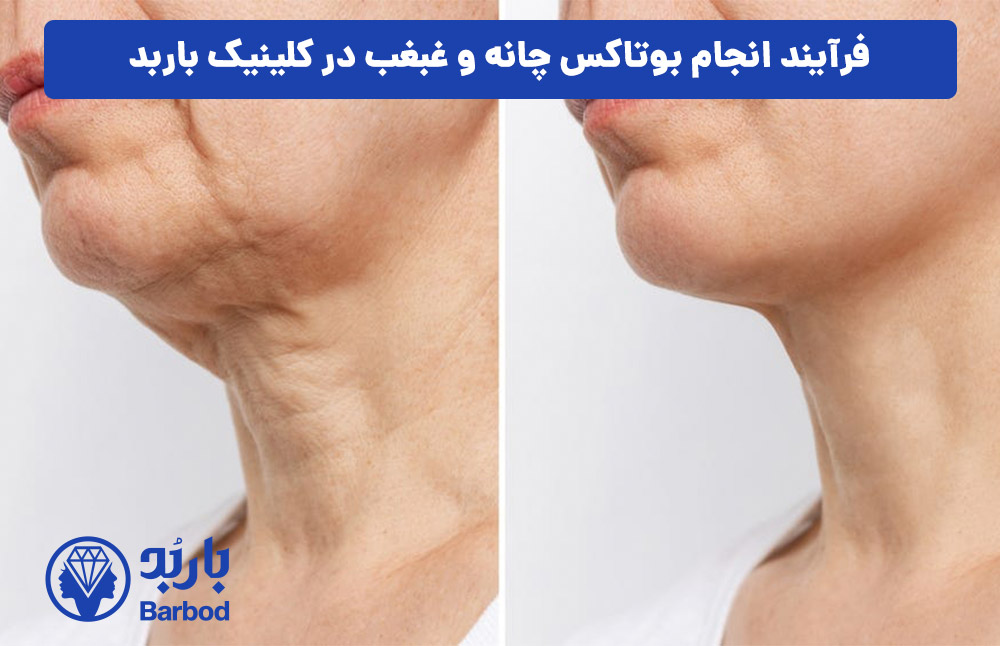 فرآیند انجام بوتاکس چانه و غبغب در کلینیک باربد
