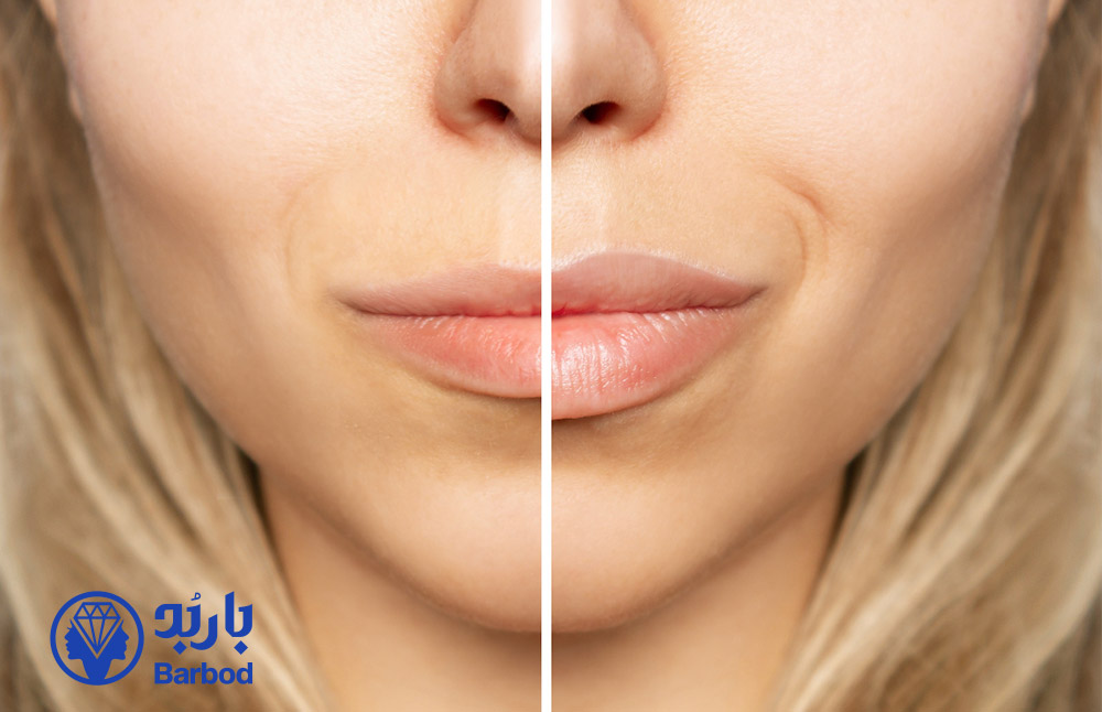 لیپ فلیپ یا فیلر لب