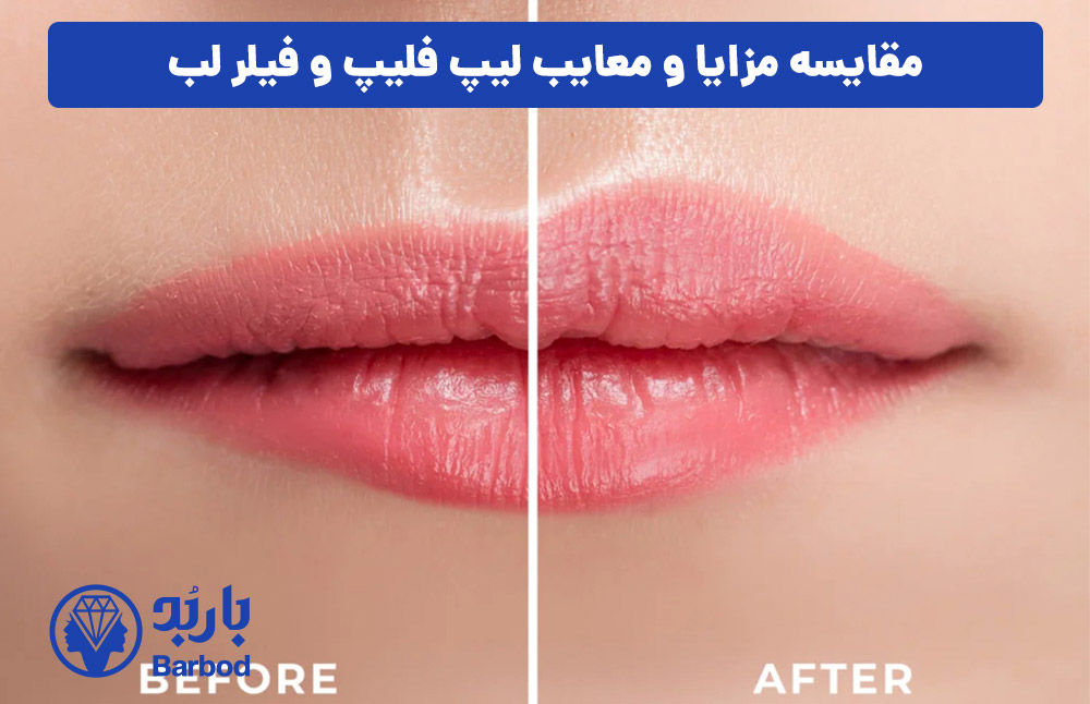 مقایسه مزایا و معایب لیپ فلیپ و فیلر لب