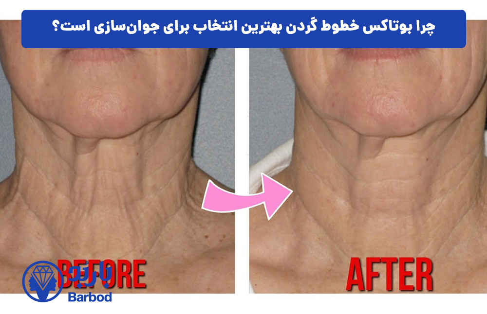 چرا بوتاکس خطوط گردن بهترین انتخاب برای جوان‌سازی است؟