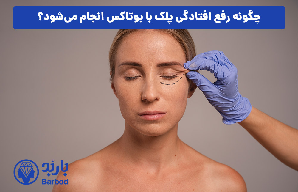چگونه رفع افتادگی پلک با بوتاکس انجام می‌شود؟
