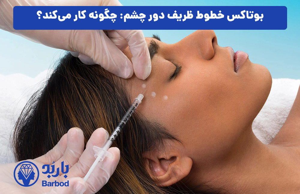 بوتاکس خطوط ظریف دور چشم: چگونه کار می‌کند؟