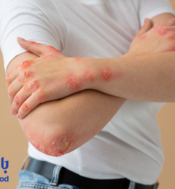 لیزر موهای زائد برای پوست‌های مبتلا به پسوریازیس