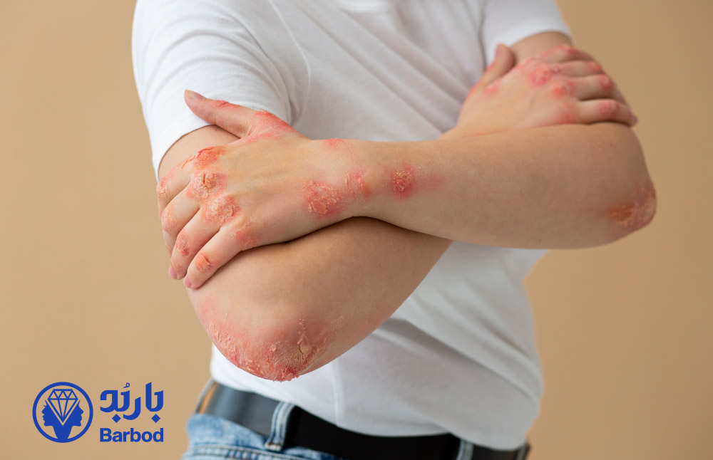 لیزر موهای زائد برای پوست‌های مبتلا به پسوریازیس