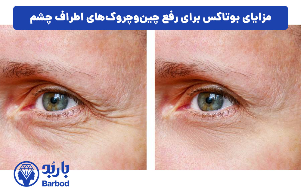 مزایای بوتاکس برای رفع چین‌وچروک‌های اطراف چشم
